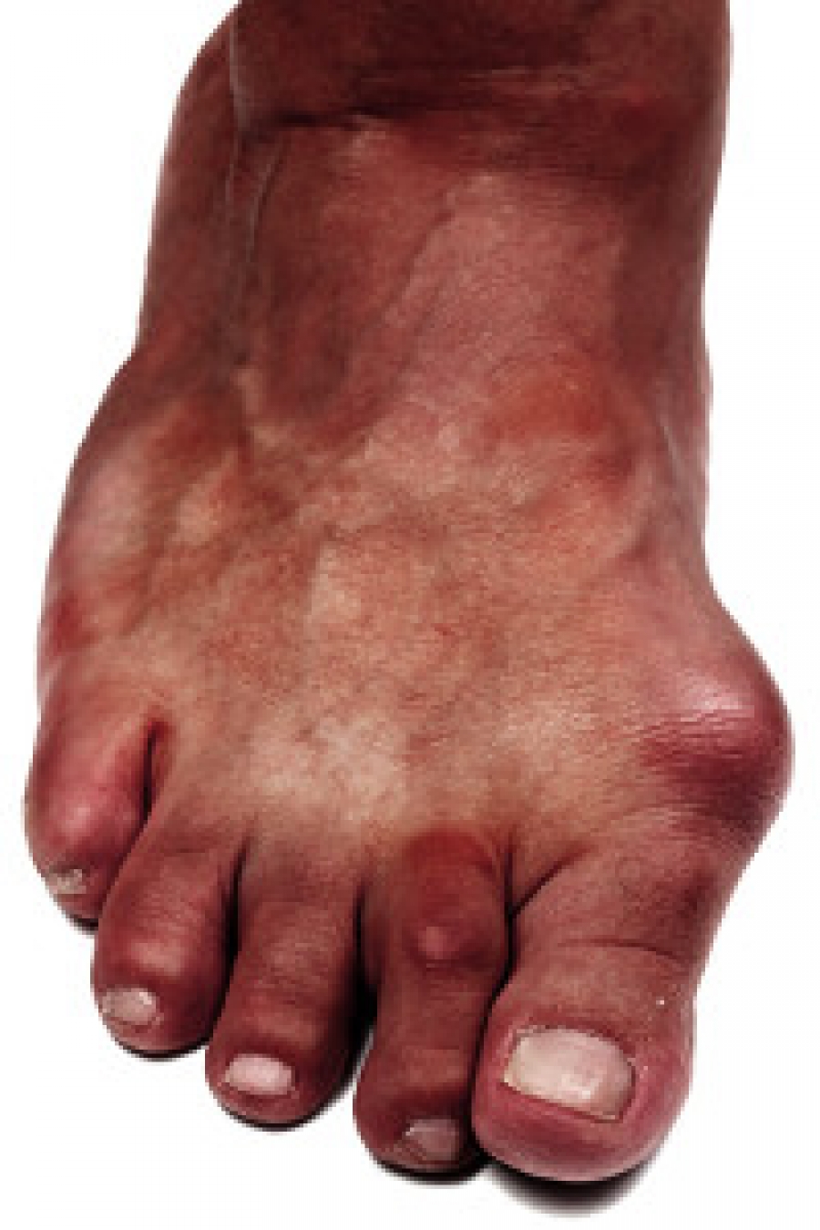 What is a Bunion?